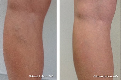 Before and After image of a leg. The before image is darker and has more bumps on it. The after image looks normal.