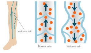 Image depicting the difference between normal and varicose veins