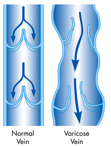 Image depicting difference between normal and varicose veins